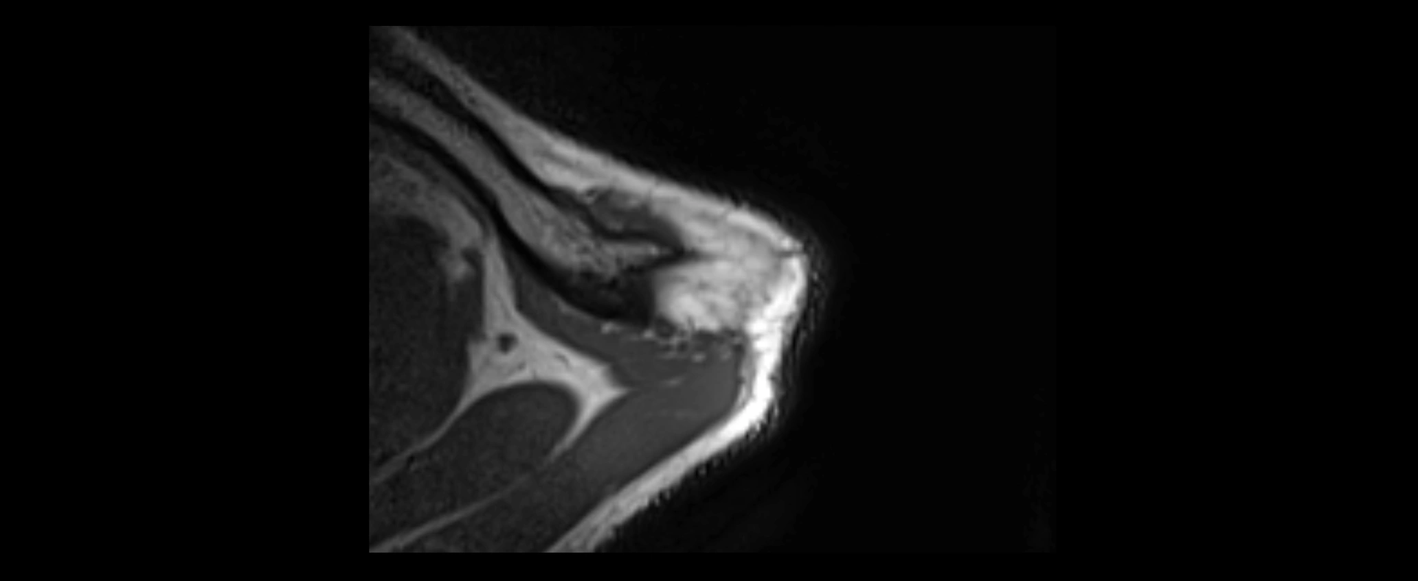 shoulder ligaments axial 3d 3t mri image-img-00005-00013.webp